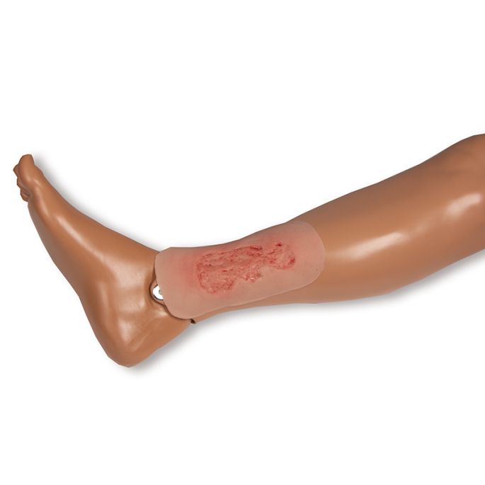 Wondmoulage veneuze beenulcus, klein, epithelisatiefase