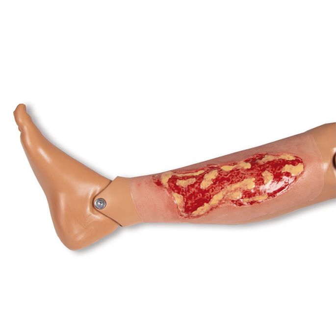 Wondmoulage veneuze beenulcus, groot, exsudatiefase