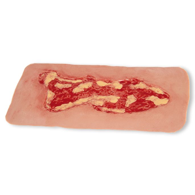 Wondmoulage veneuze beenulcus, groot, exsudatiefase