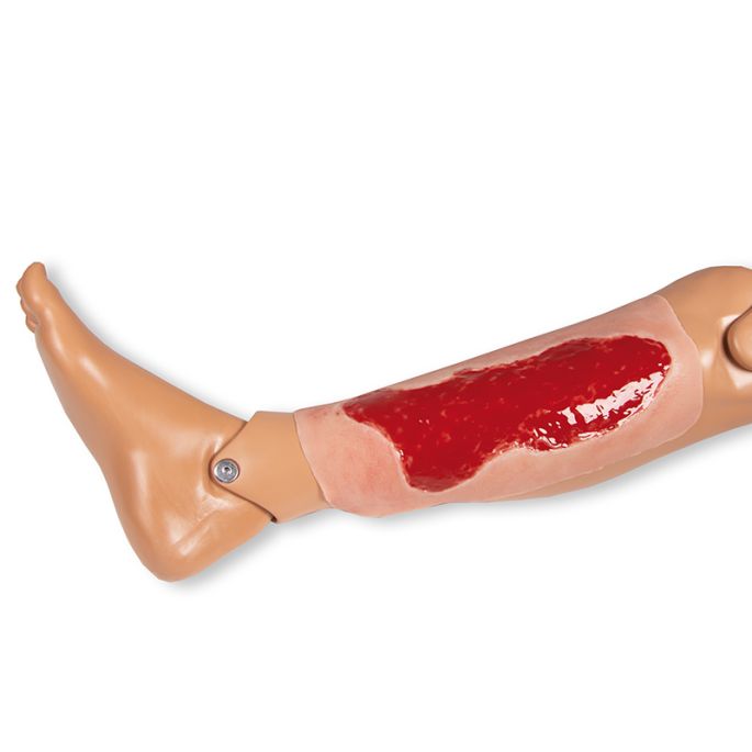 Wondmoulage veneuze beenulcus, groot, granulatiefase