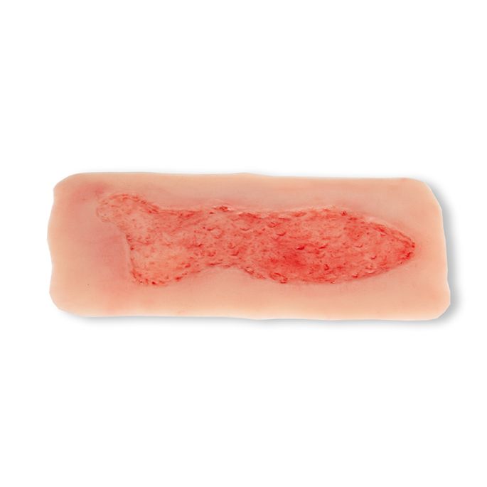 Wondmoulage veneuze beenulcus, groot, epithelisatiefase