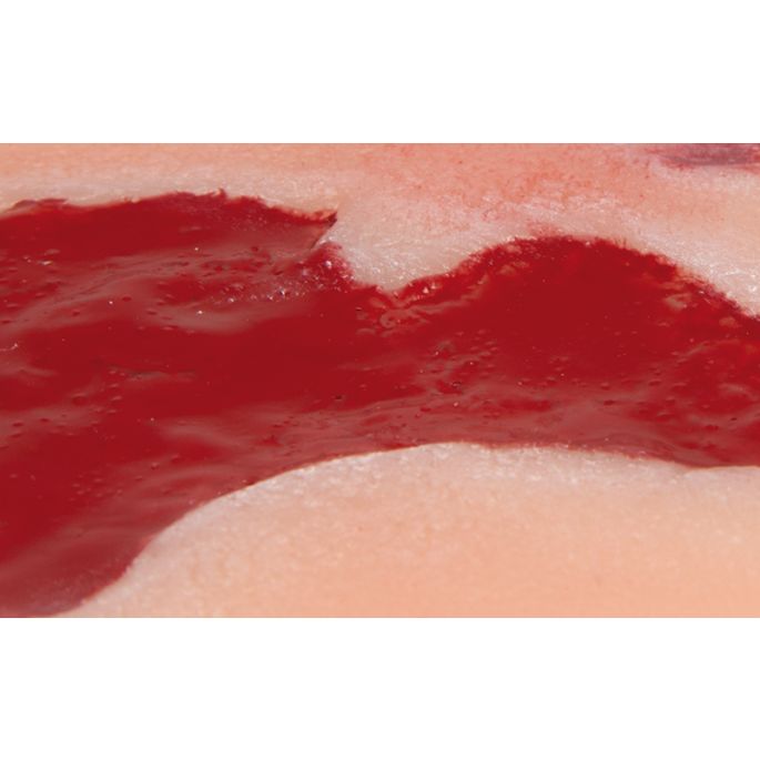 Wondmoulage arteriële beenulcus, klein, granulatiefase