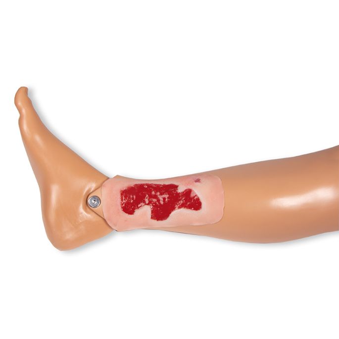 Wondmoulage arteriële beenulcus, klein, granulatiefase