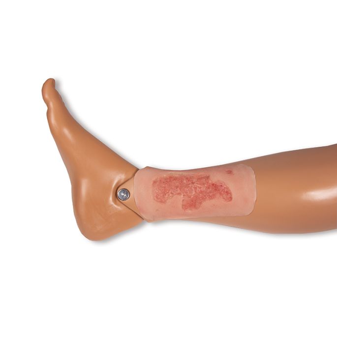Wondmoulage arteriële beenulcus, klein, epithelisatiefase