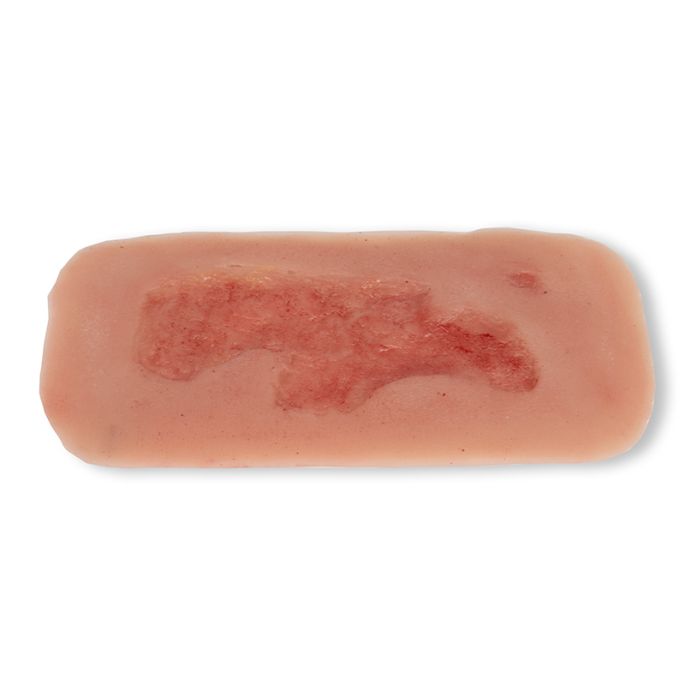 Wondmoulage arteriële beenulcus, klein, epithelisatiefase
