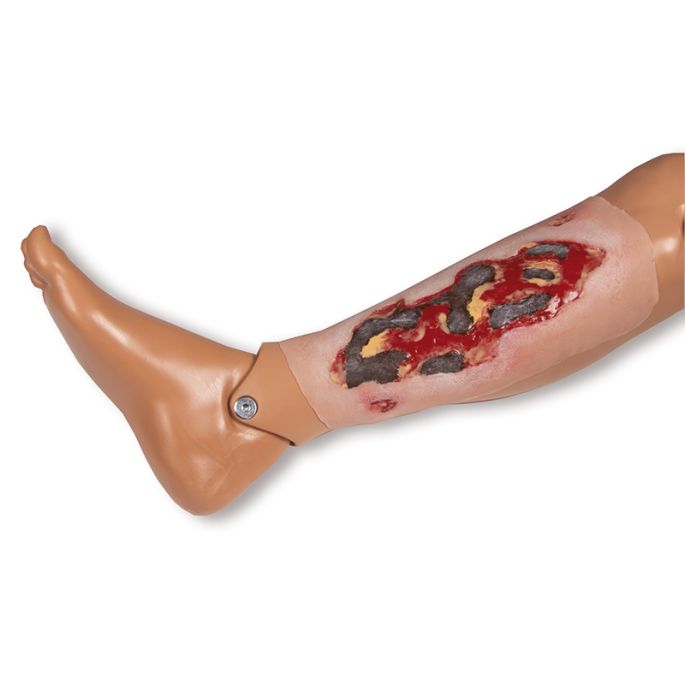 Wondmoulage arteriële beenulcus, groot, exsudatiefase