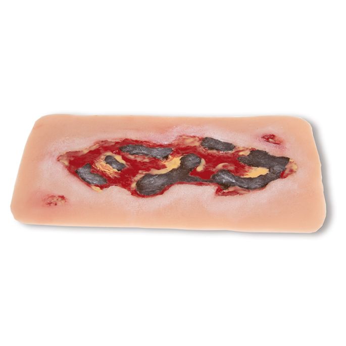 Wondmoulage arteriële beenulcus, groot, exsudatiefase
