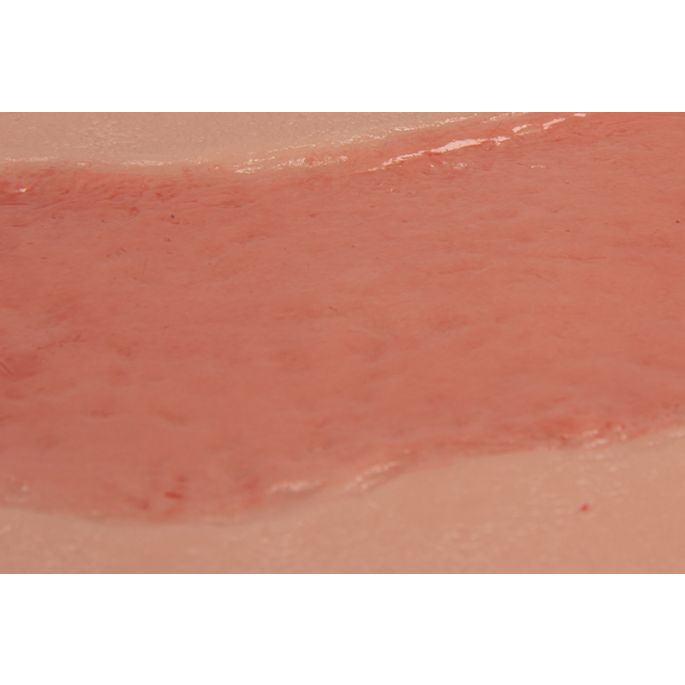 Wondmoulage arteriële beenulcus, groot, epithelisatiefase