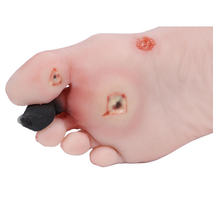 Wondvoet met diabetisch voetsyndroom