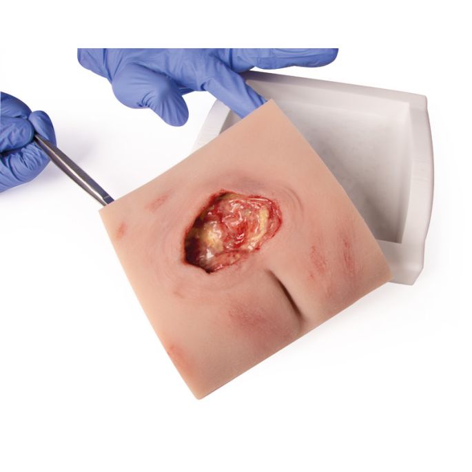 Wondmoulage sacrale decubitus, gereinigd inclusief standaard