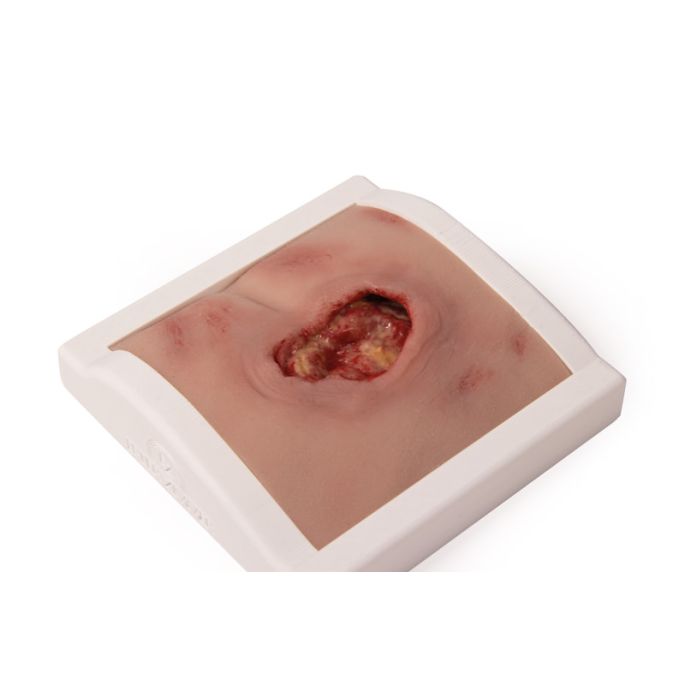 Wondmoulage sacrale decubitus, gereinigd inclusief standaard