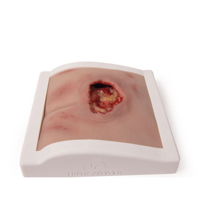 Wondmoulage sacrale decubitus, gereinigd inclusief standaard