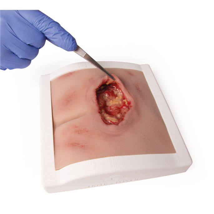 Wondmoulage sacrale decubitus, gereinigd inclusief standaard