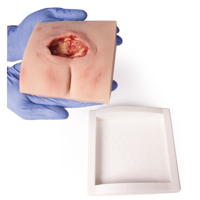 Wondmoulage sacrale decubitus, gereinigd inclusief standaard
