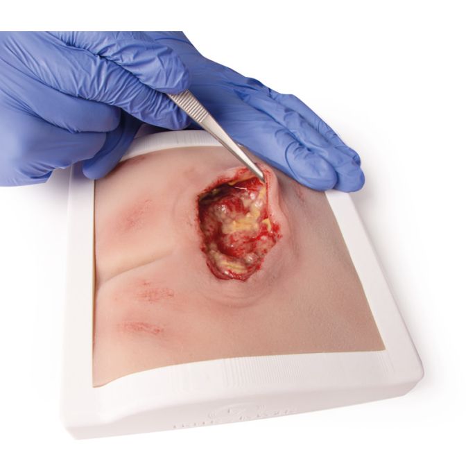Wondmoulage sacrale decubitus, gereinigd inclusief standaard