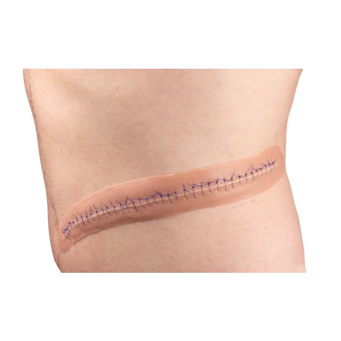 Chirurgische wond, met hechting, 22 cm