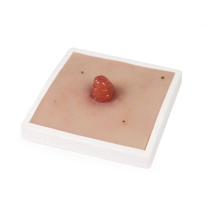 Wondmoulage Ileostoma, incl. stellage