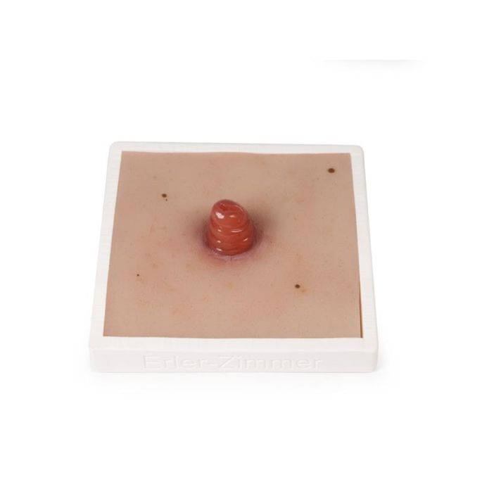 Wondmoulage Ileostoma, incl. stellage