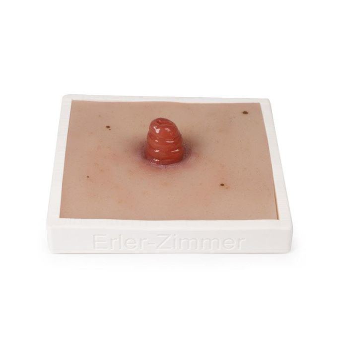 Wondmoulage Ileostoma, incl. stellage