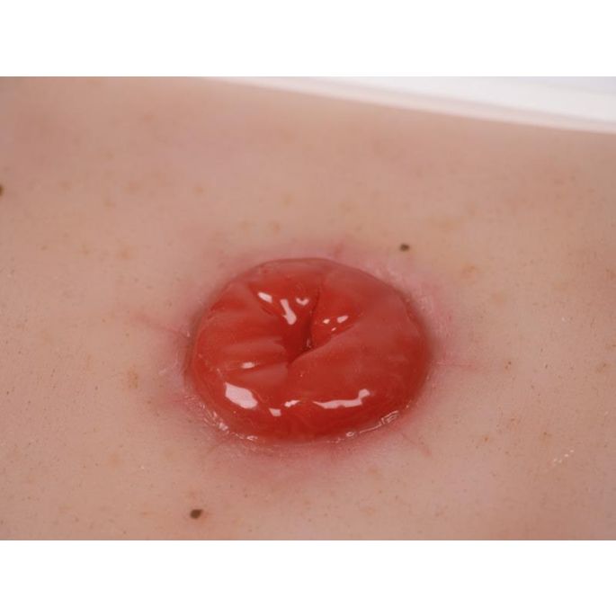 Wondmoulage Colostoma, incl. stellage