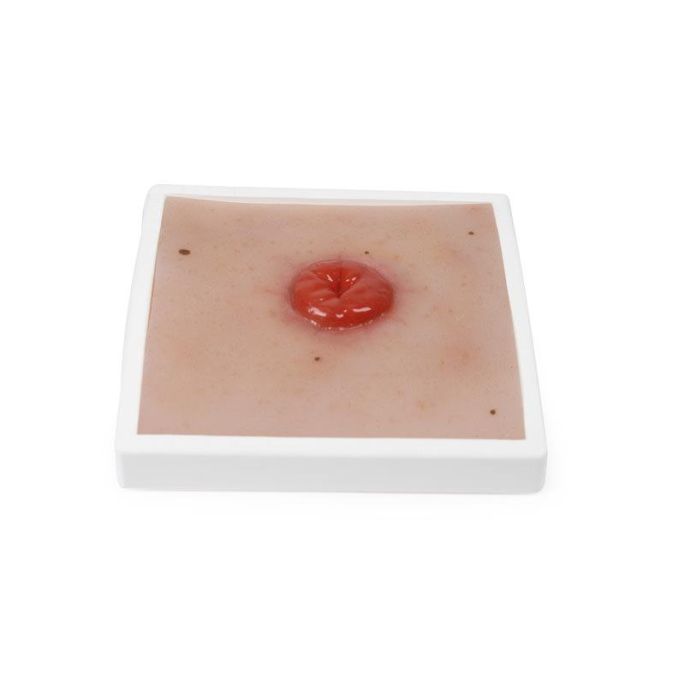 Wondmoulage Colostoma, incl. stellage