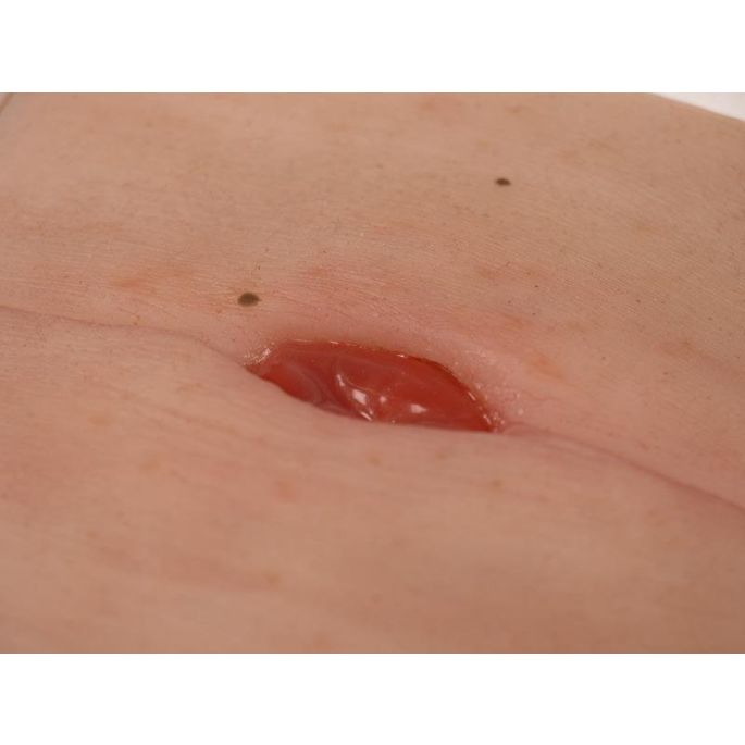 Wondmoulage Colostoma in buikplooi, incl. stellage