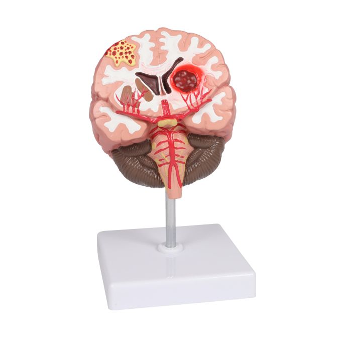Hersenpathologieën