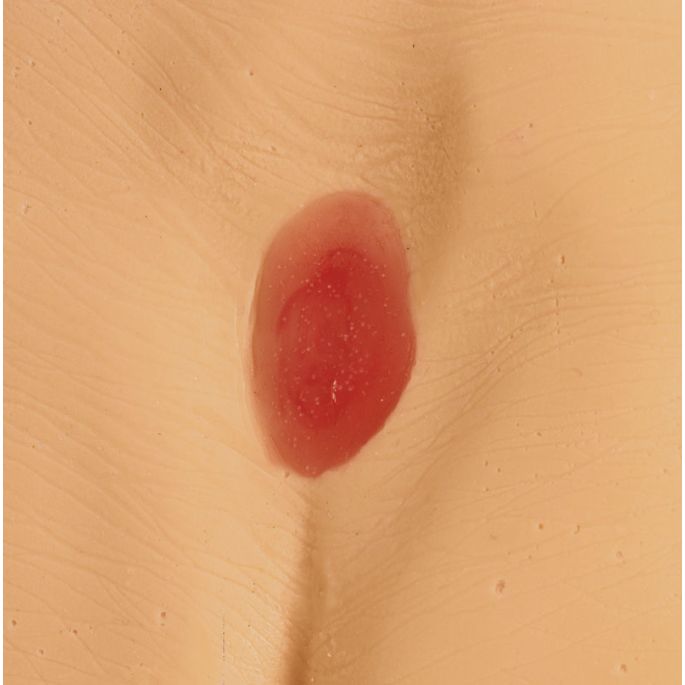 Modellen voor decubitus/doorligwonden