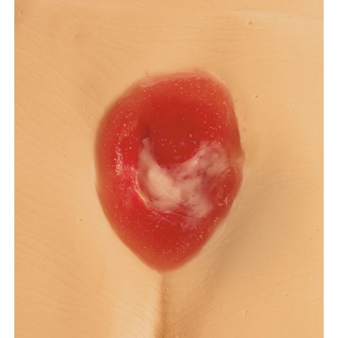 Modellen voor decubitus/doorligwonden