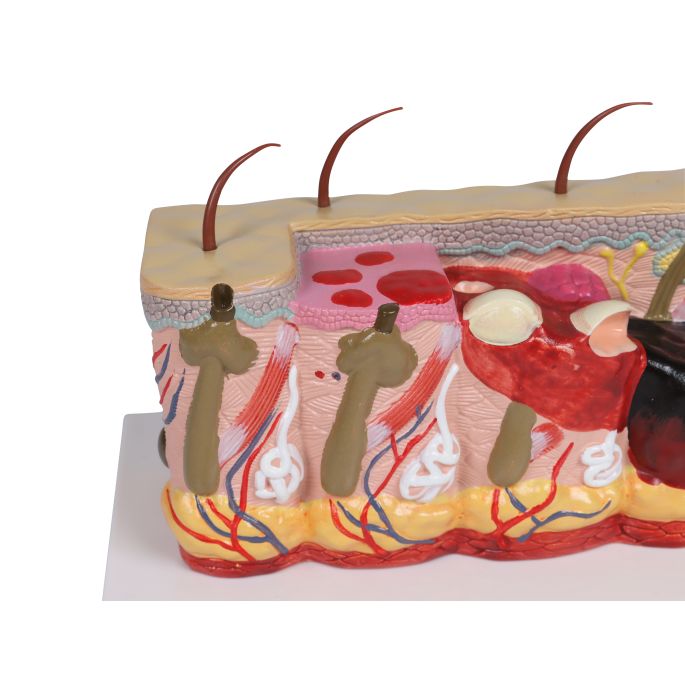 Pathologisch huidmodel met brandwonden