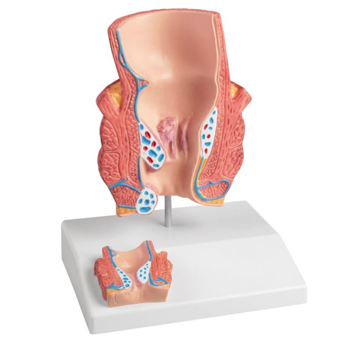 Aambeien model