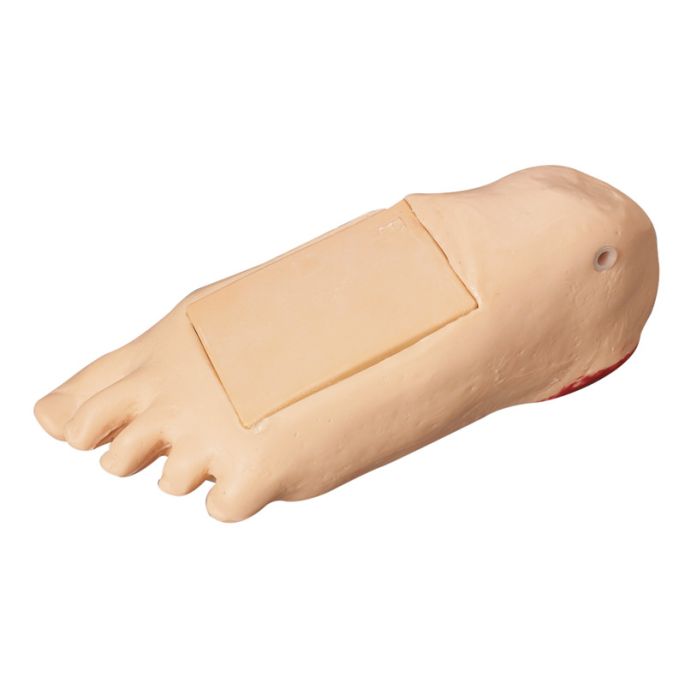 Oedeemvoet met diep weefselletsel voor GERI/KERI - afbeelding 2
