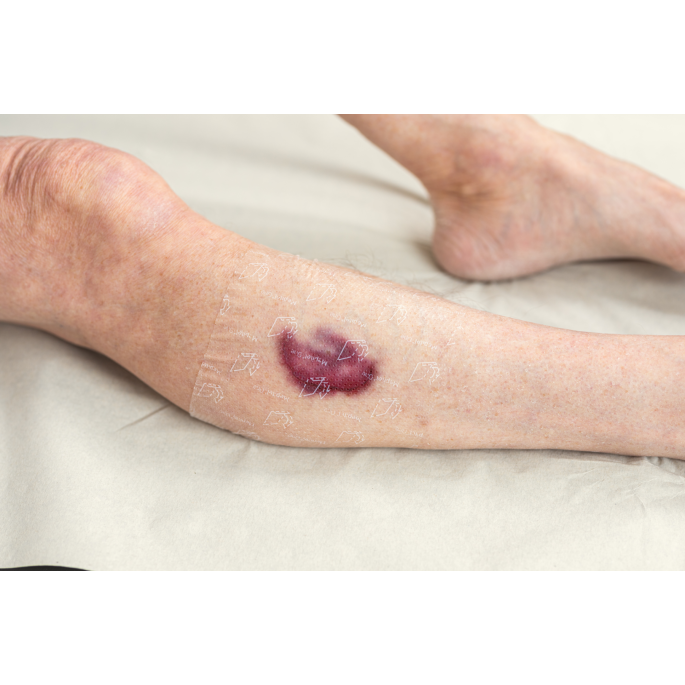 Mepitel One wondcontactlaag (voor skin tears), 13 x 15 cm, 5 x 1 stuk