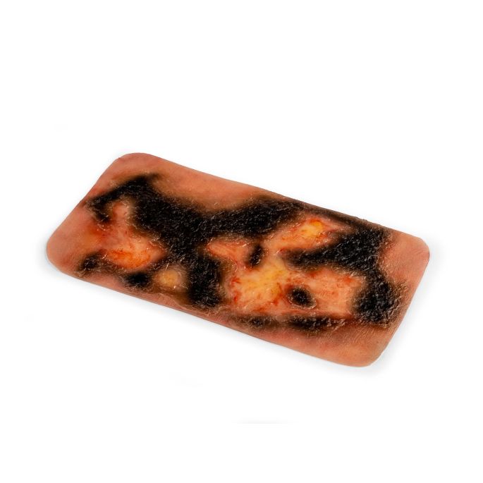 Wondmoulage 3e graads brandwond - afbeelding 4