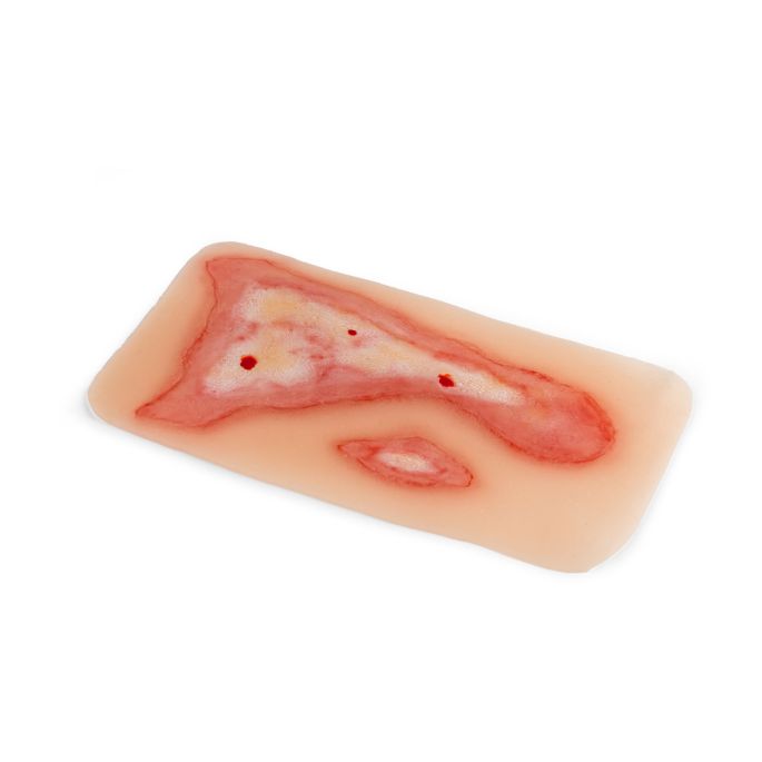 Wondmoulage broeien - afbeelding 4