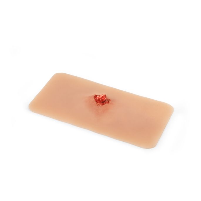 Wondmoulage open fractuur