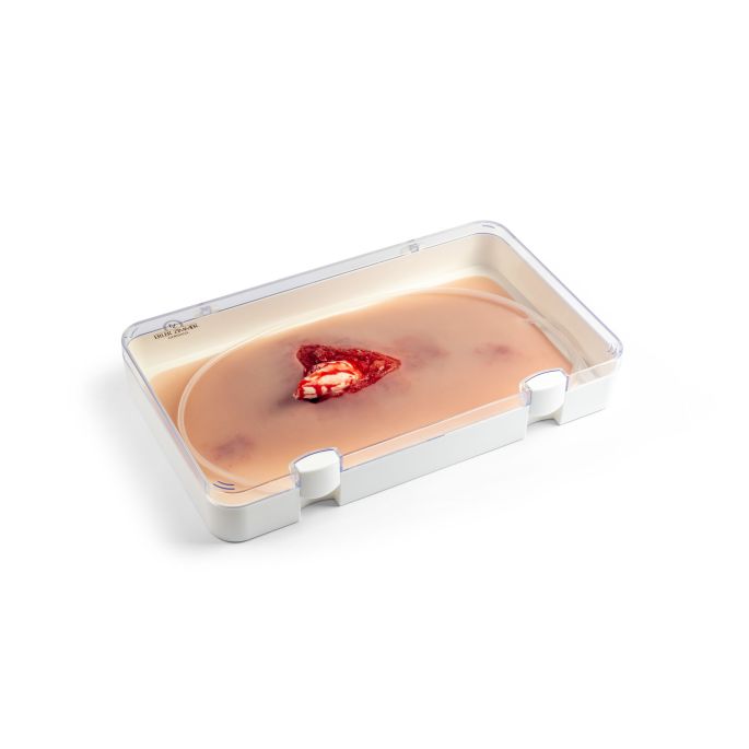 Wondmoulage open fractuur
