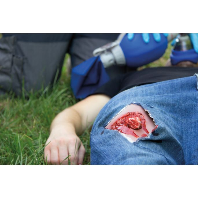 Wondmoulage open fractuur