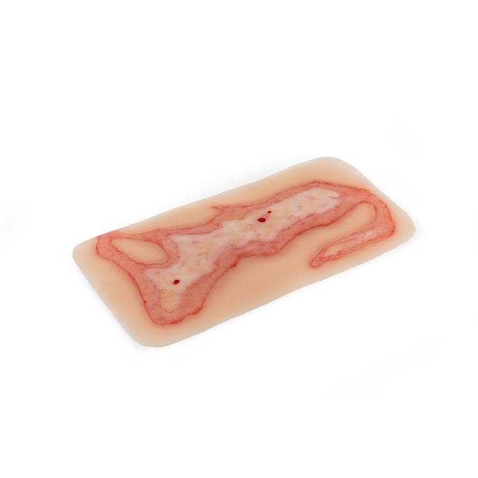 Wondmoulage broeien (V2) - afbeelding 3