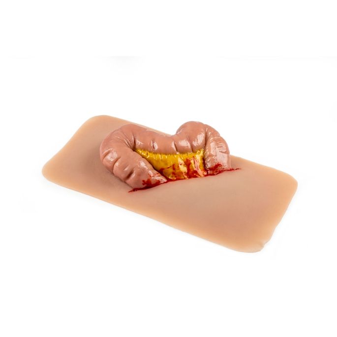 Wondmoulage uitsteeksel van de dikke darm - afbeelding 8