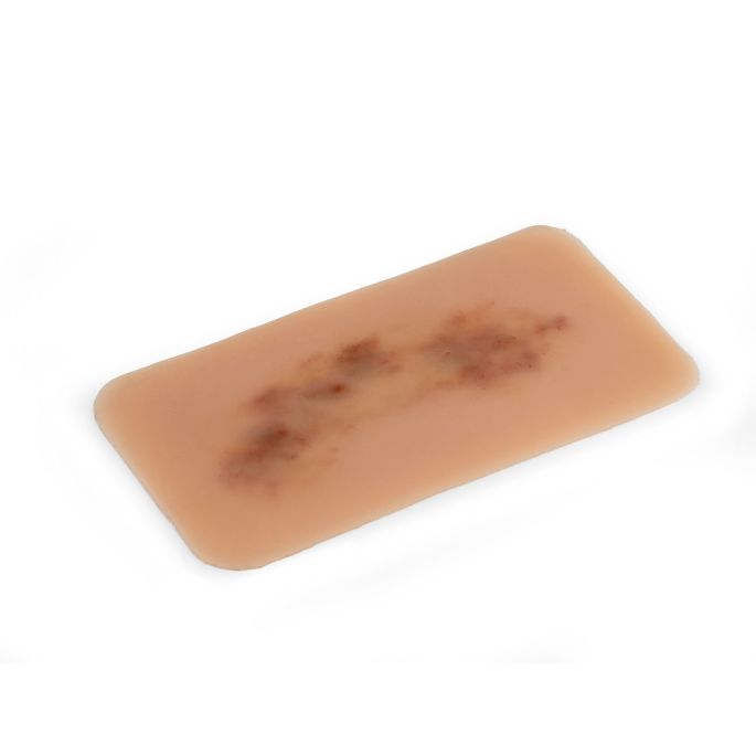 Wondmoulage hematoom vers - afbeelding 3