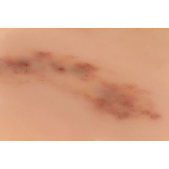 Wondmoulage hematoom vers - afbeelding 5