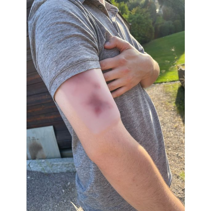 Wondmoulage hematoom vers - afbeelding 7