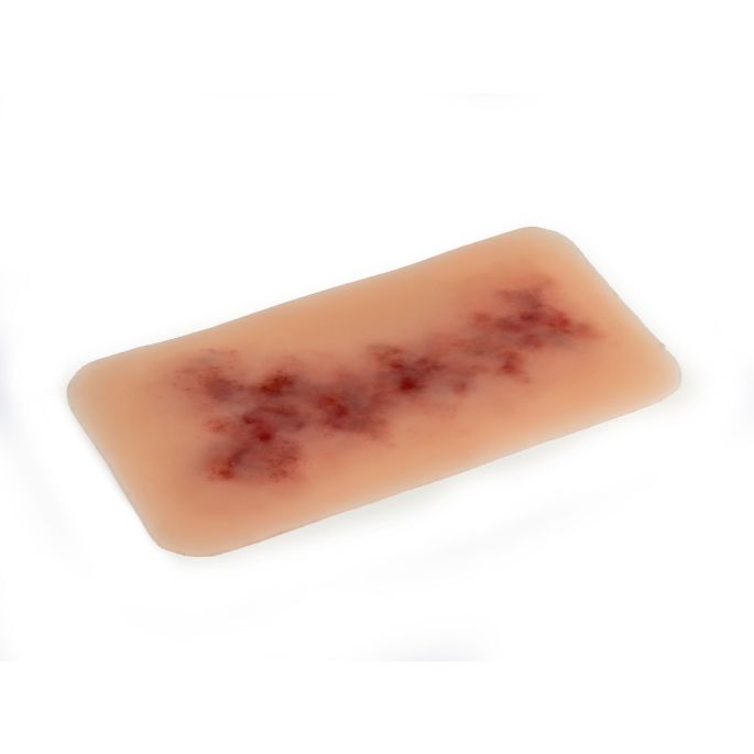 Wondmoulage Hematoom ouder - afbeelding 3