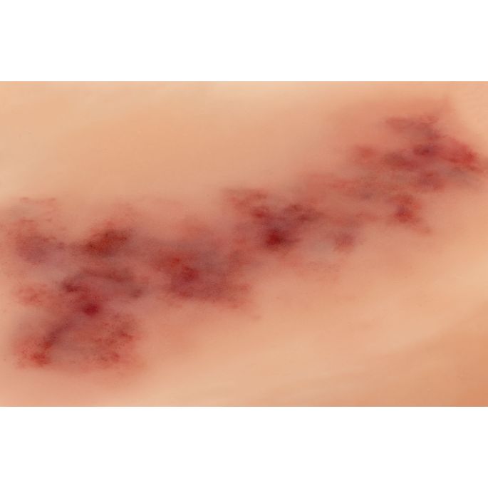 Wondmoulage Hematoom ouder - afbeelding 5