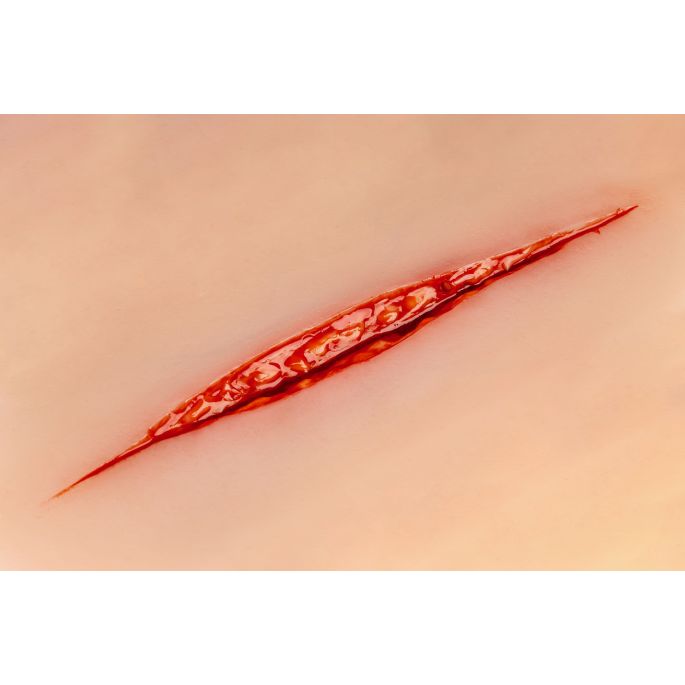 Wondmoulage Zelfmoordpoging - afbeelding 5
