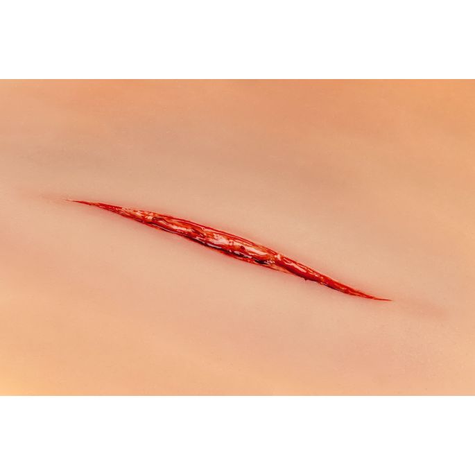 Wondmoulage Keelsnede - afbeelding 5