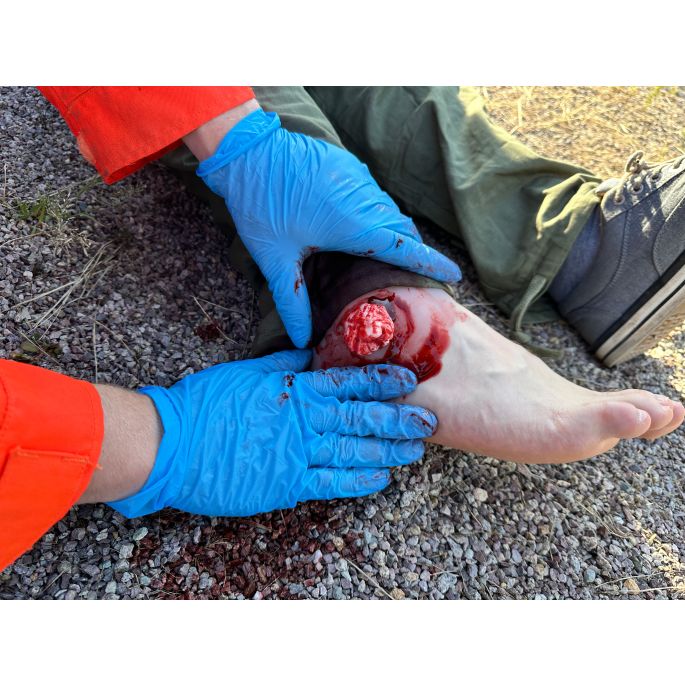 Wondpresentatie open fractuur enkelgewricht - afbeelding 8