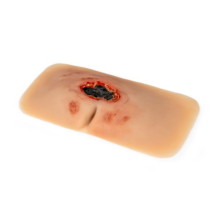 Wondmoulage sacrale decubitus