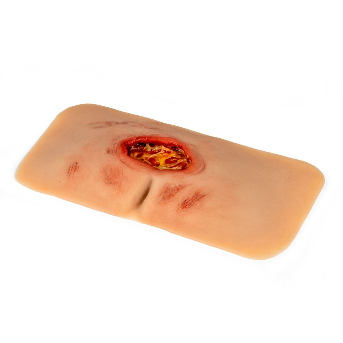 Wondmoulage sacrale decubitus